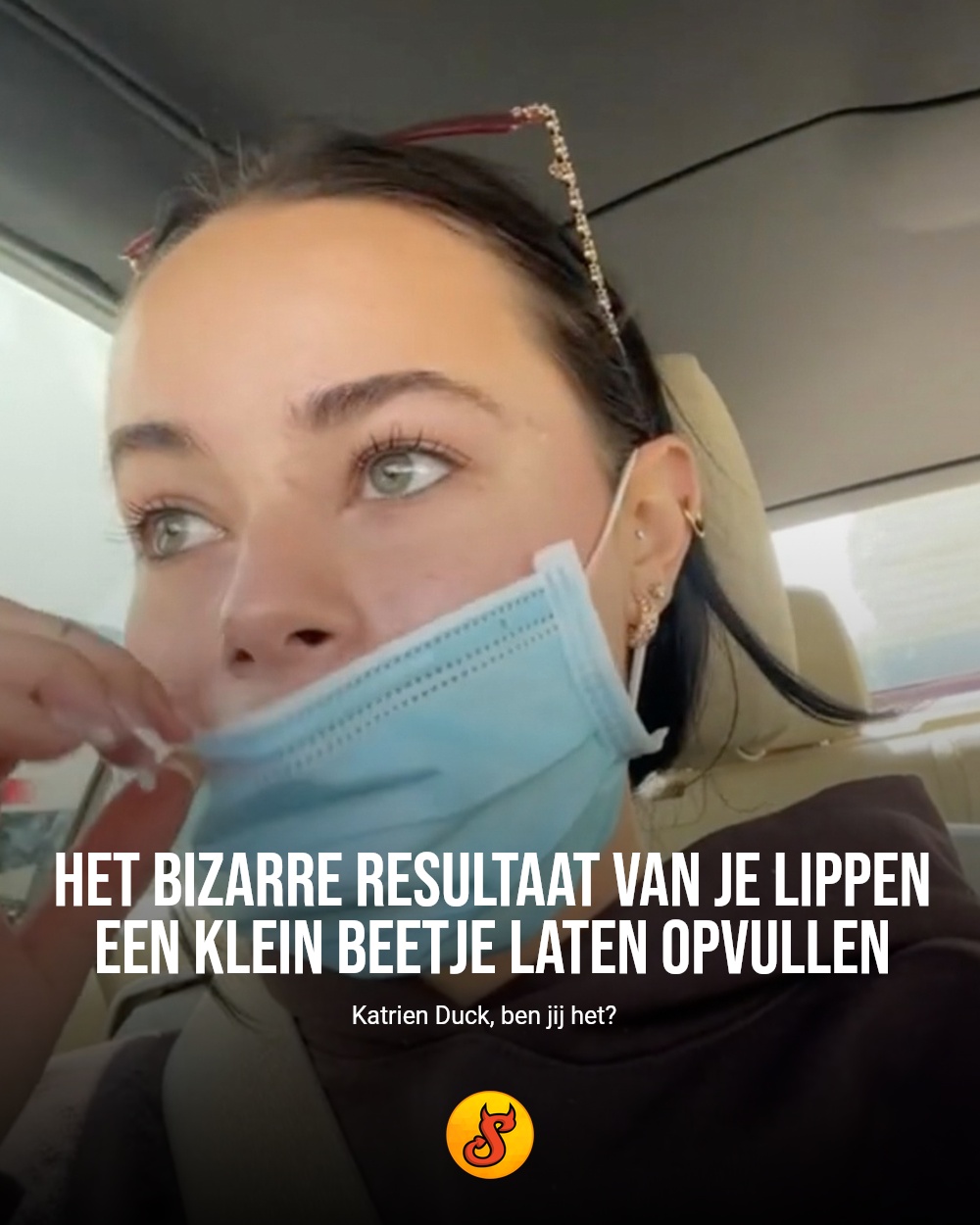 Het bizarre resultaat van je lippen een klein beetje laten opvullen