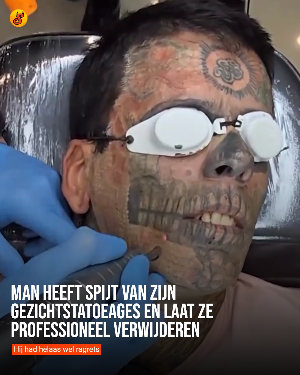 Man heeft spijt van zijn gezichtstatoeages en laat ze professioneel verwijderen