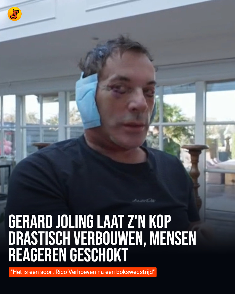 Gerard Joling laat z'n kop drastisch verbouwen, mensen reageren geschokt