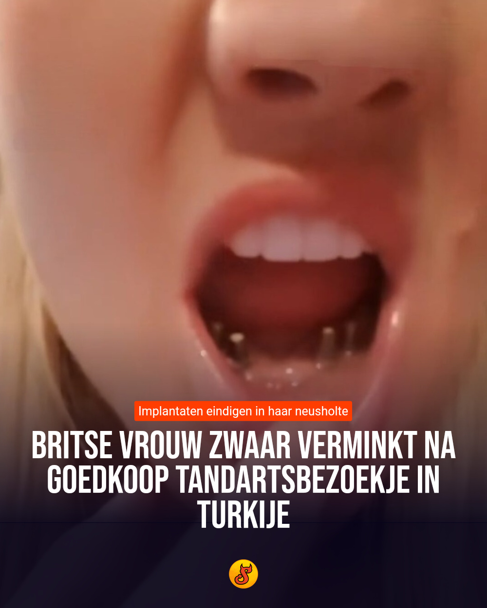 Britse vrouw zwaar verminkt na goedkoop tandartsbezoekje in Turkije