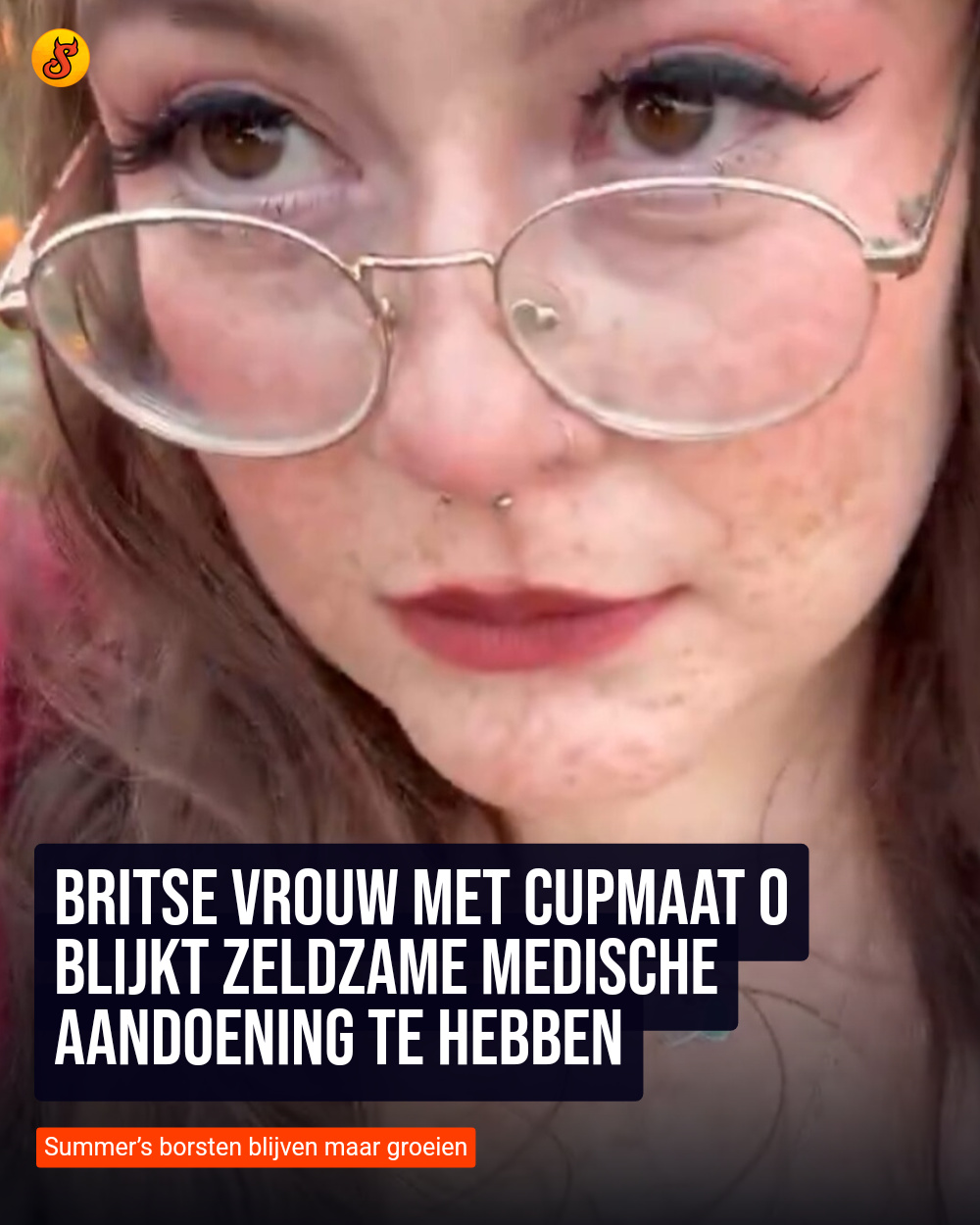 Britse vrouw met cupmaat O blijkt zeldzame medische aandoening te hebben