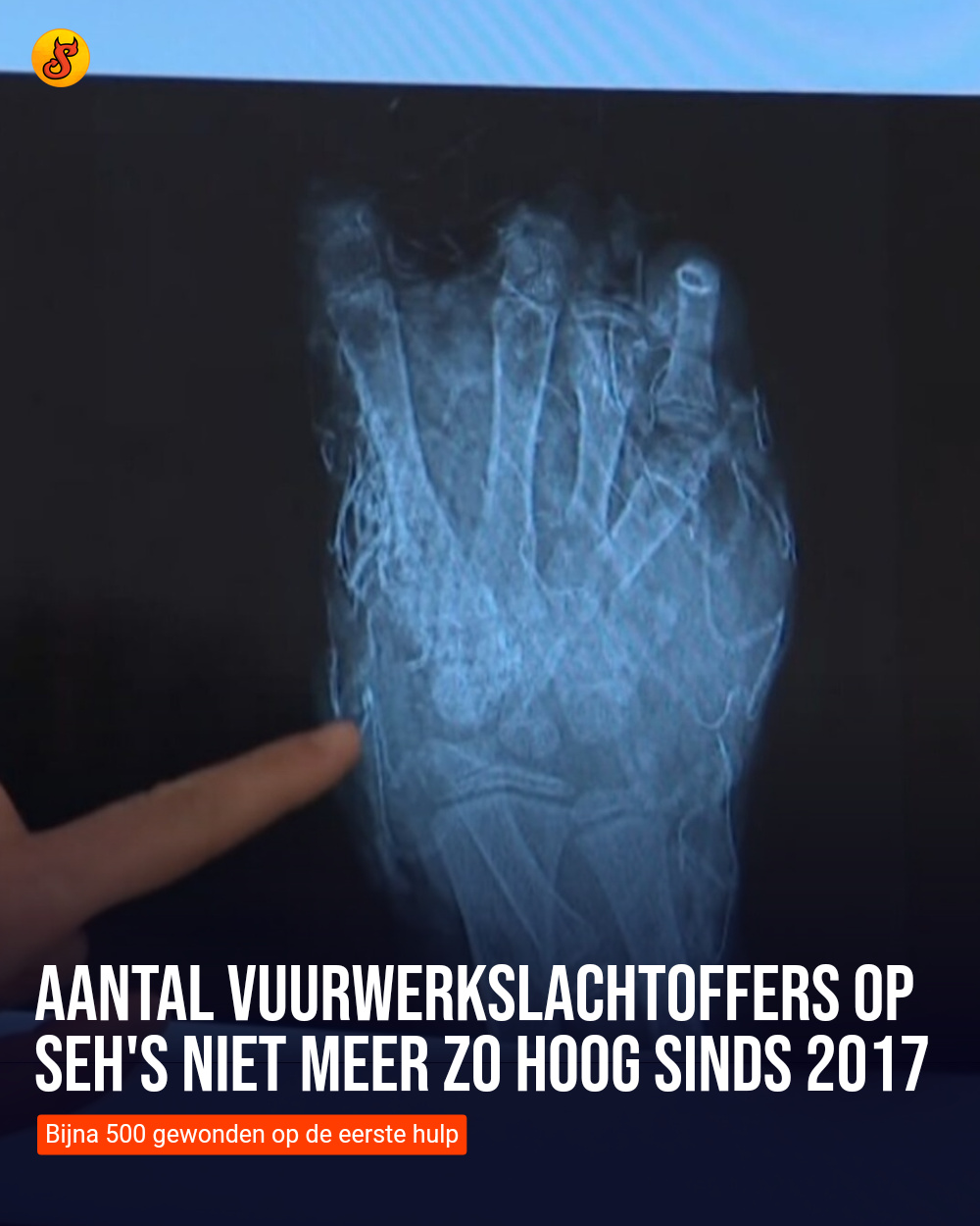 Aantal vuurwerkslachtoffers op SEH's niet meer zo hoog sinds 2017