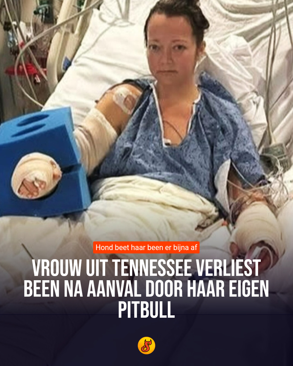 Vrouw uit Tennessee verliest been na aanval door haar eigen pitbull