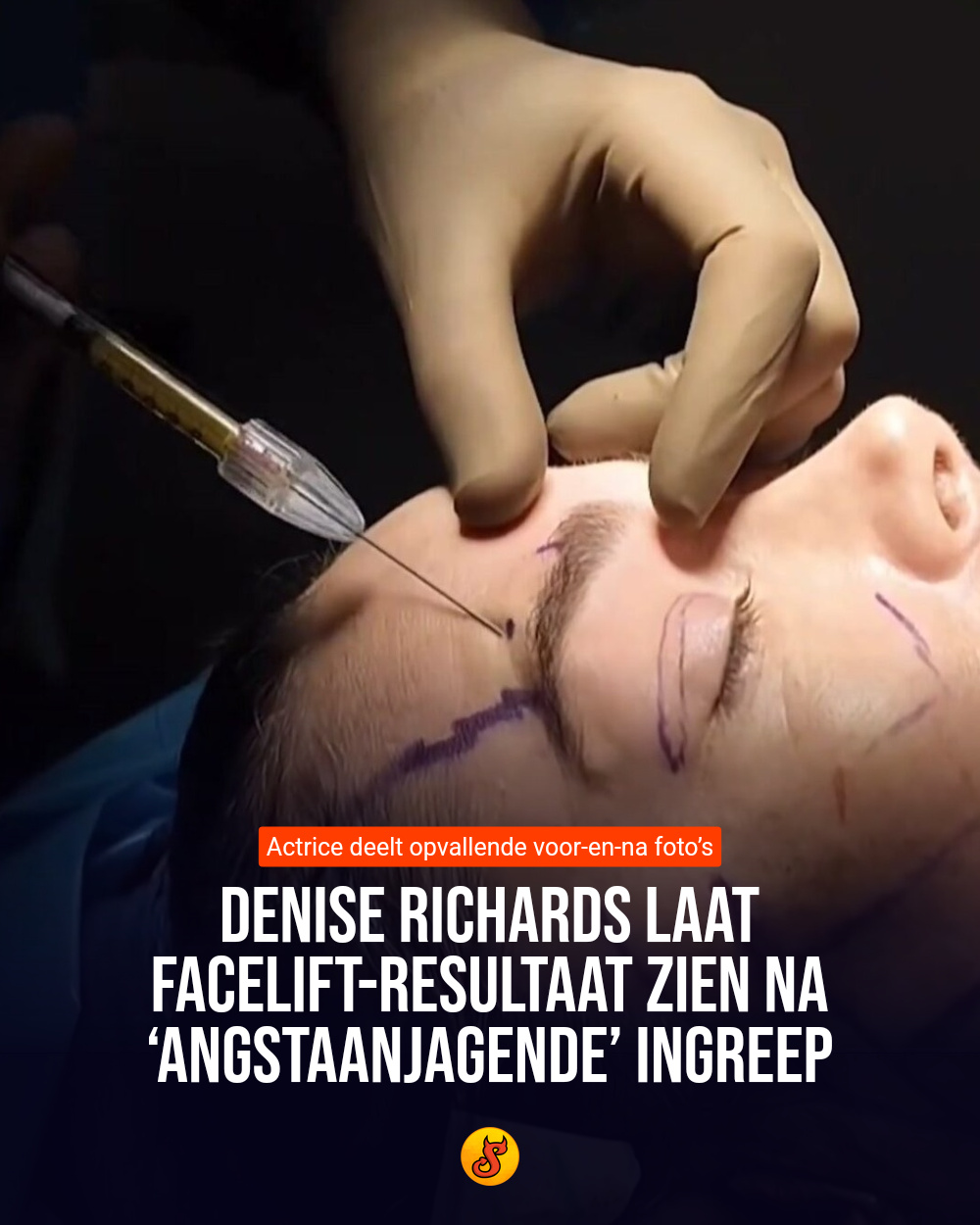 Denise Richards laat facelift-resultaat zien na ‘angstaanjagende’ ingreep