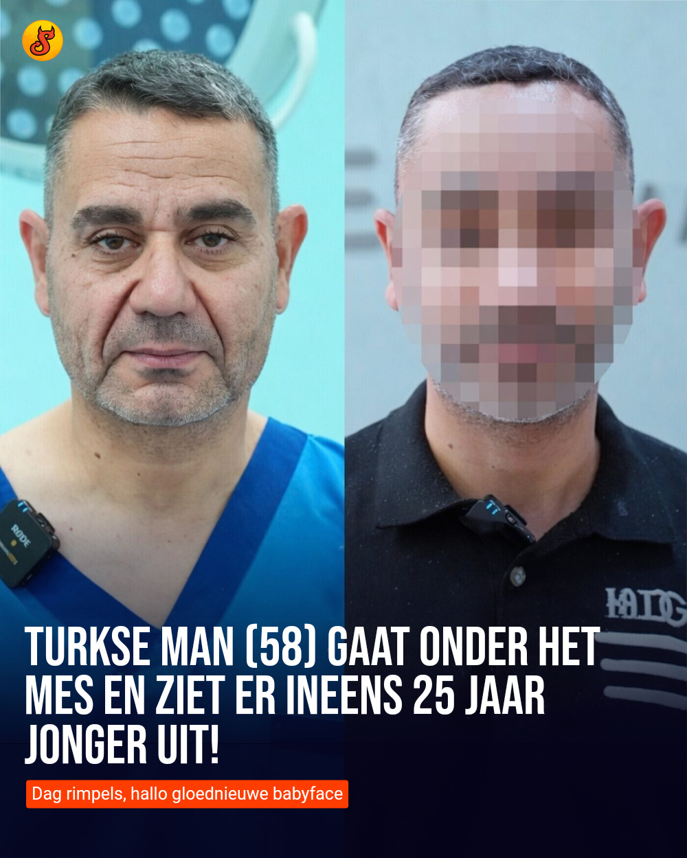Turkse man (58) gaat onder het mes en ziet er ineens 25 jaar jonger uit!