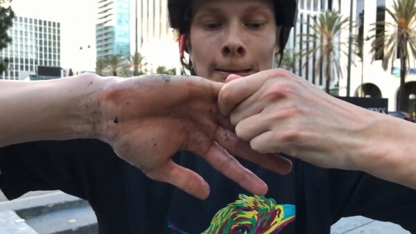 BMX-er zet zijn vinger vakkundig goed nadat hij pijnlijk terechtkomt