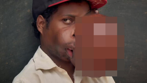 Man ondergaat heftige operatie om 5 kilo wegende gezichtstumor te verwijderen