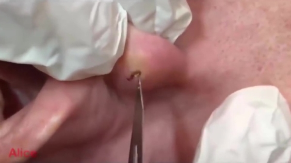 Dokter trekt een complete pot mayonaise achter man zijn oor vandaan