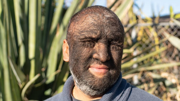 Amerikaanse "Wolf Man" is voor 95% bedekt met haar