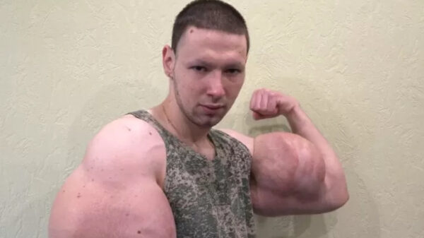 Russische 'Popeye' moet weer onder het mes en is bang armen te verliezen