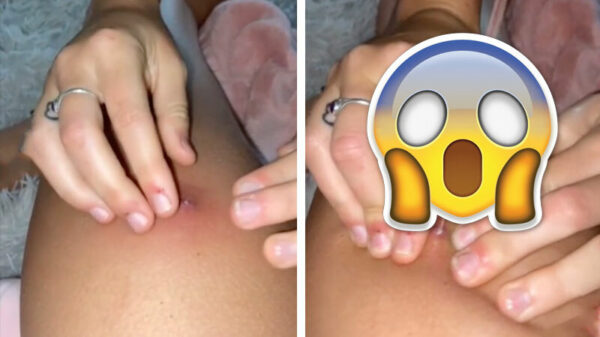 Nieuw afstandsrecord door plaatselijke vulkaanuitbarsting op bovenbeen