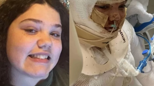 13-jarige belandt met 3e-graads brandwonden in ziekenhuis na TikTok-challenge