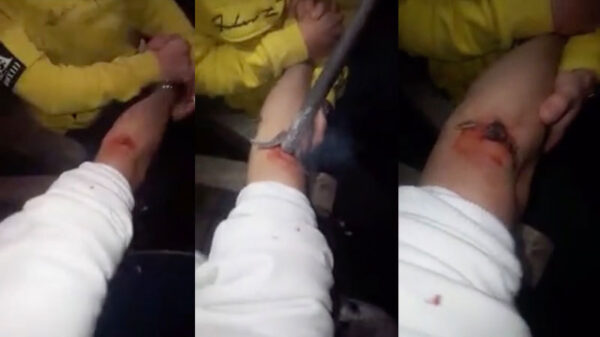 Net als in de film: wondje dichtbranden met een heet ijzer