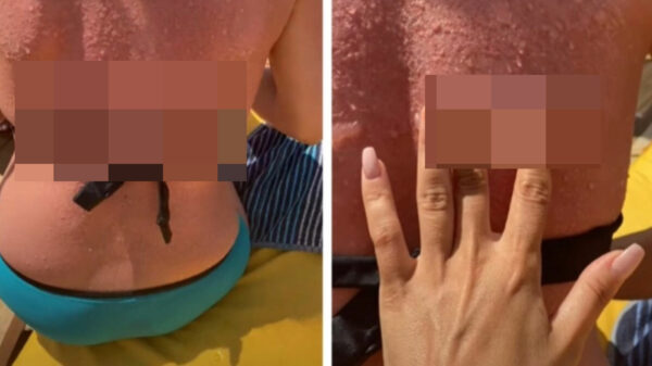 Het pijnlijke resultaat van urenlang bakken in de zon zonder je in te smeren