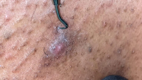 Het los pulken van ingegroeide haren blijft op een of andere manier fascinerend