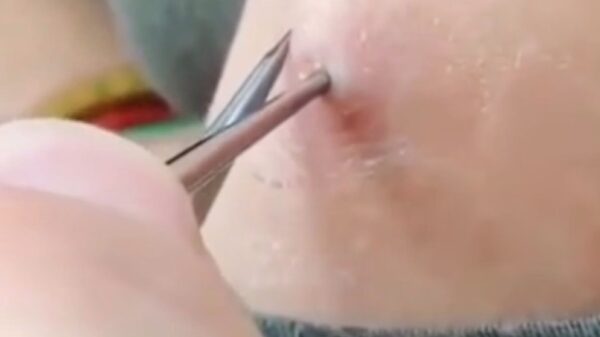 Ranzige horzel-larve wordt uit iemands been geplukt