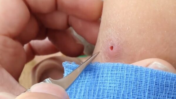 Vrouw ontdekt tijdens vakantietripje een aantal nieuwe passagiers in haar arm