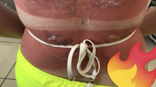 De extreem verbrande rug van de 16-jarige Maisie Squires na een middagje snorkelen op Cuba