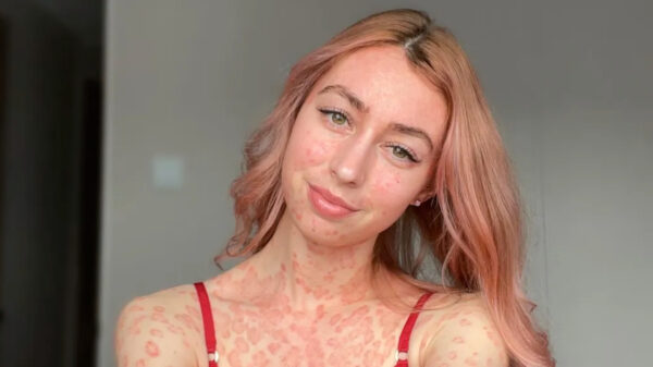 Claire Spurgin heeft haar psoriasis omarmd en poseert nu graag in lingerie