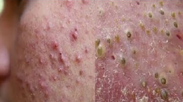 Het blijft fascinerend om te zien hoe mee-eters eruit worden gepulkt