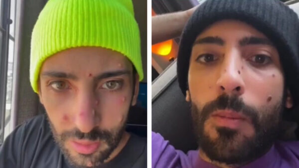 Man met apenpokken deelt zijn ervaringen en waarschuwt voor de gevolgen