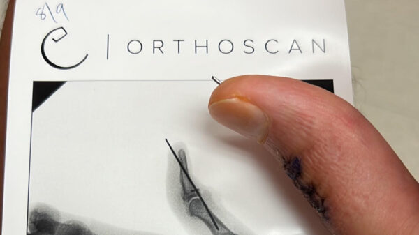 Het grote nadeel van een metalen pin in je duim: hij moet er ook weer uit