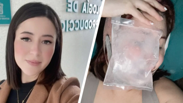 Diana Contreras deelt gruwelijke foto's van haar gezicht na complicaties bij cosmetische chirurgie