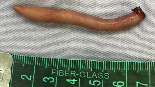 Creepy: meisje in Mexico geboren met echte staart met haar