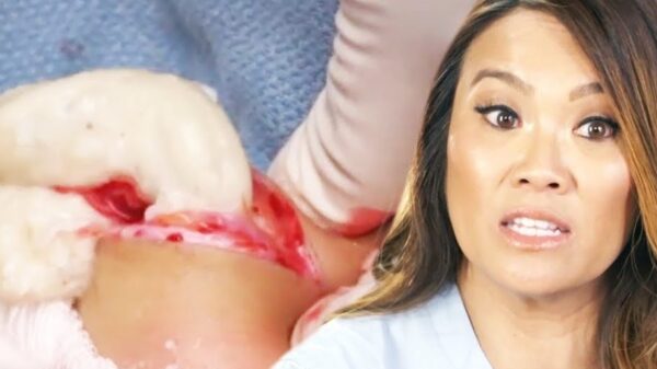 Dr. Pimple Popper gaat los op een enorme cyste in een meisje d'r nek