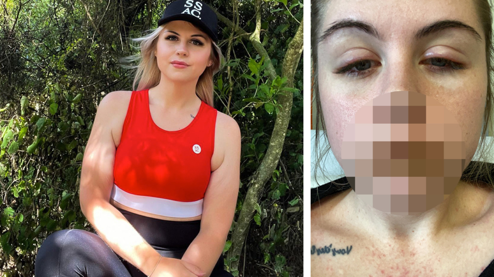 26-jarige moeder krijgt bizarre allergische reactie op medicijnen