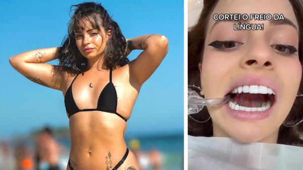 De Braziliaanse Rochelle Garett laat haar tongriem doorsnijden en kan nu tongen als de beste