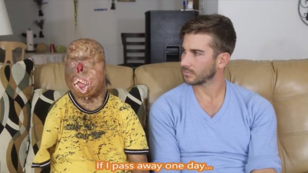 Overlever van extreme brandwonden wil alleen maar aardig gevonden worden