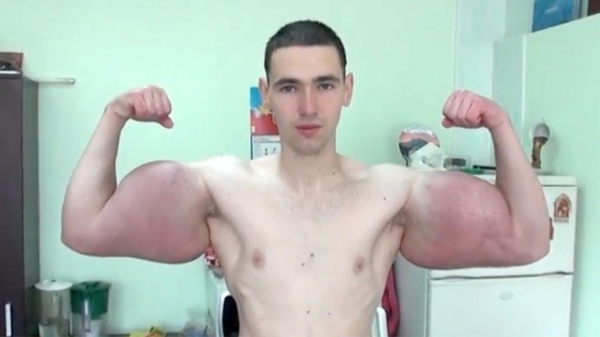 Onze grote Russische vriend Kirill Tereshin is dankzij operatie van zijn ontstoken armen verlost
