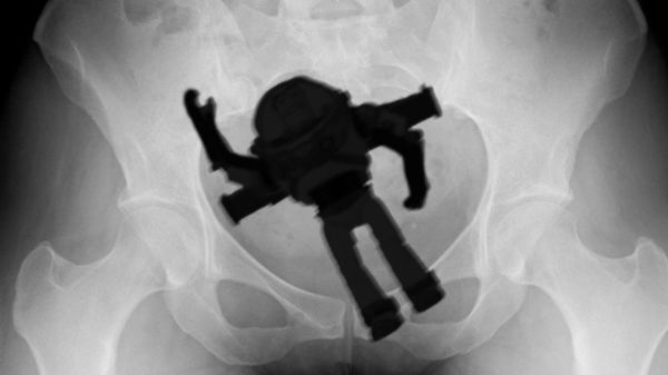 Dit zijn de meest bizarre dingen die ooit in mensenlichamen werden aangetroffen