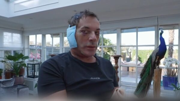 Gerard Joling laat z'n kop drastisch verbouwen, mensen reageren geschokt