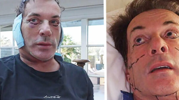 Gerard Joling laat z'n kop drastisch verbouwen, mensen reageren geschokt