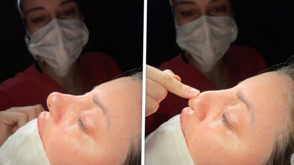 Waarschijnlijk de meest bizarre neuscorrectie dit je dit jaar zult zien