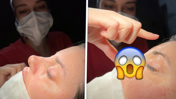 Waarschijnlijk de meest bizarre neuscorrectie dit je dit jaar zult zien