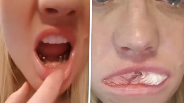 Britse vrouw zwaar verminkt na goedkoop tandartsbezoekje in Turkije