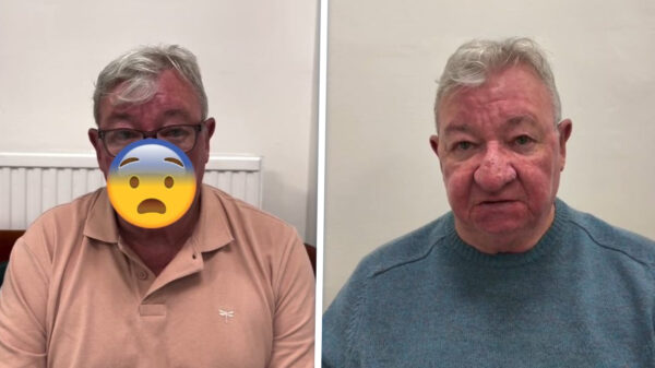 Schotse opa kon jaren zijn vrouw niet kussen door bizar opgezwollen neus