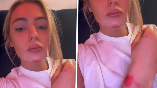 Jutta Leerdam aangereden door automobilist: "Hij zat op z’n telefoon"