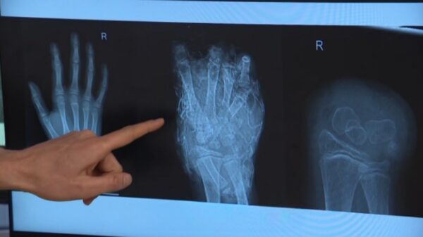 Aantal vuurwerkslachtoffers op SEH's niet meer zo hoog sinds 2017