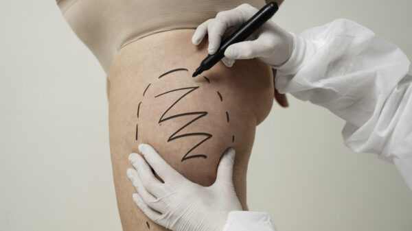 ‘Zombie filler’ met lijkvet: Nieuwe hype voor nep-spieren en volle billen