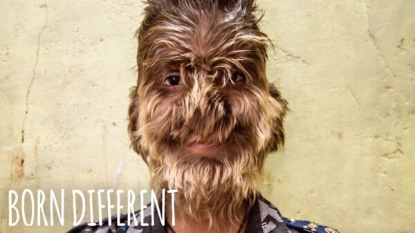 Indiase jongen lijdt aan het weerwolf-syndroom en heeft abnormale haargroei