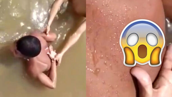 Braziliaan heeft een Candiru in zijn rug maar mag toch van geluk spreken