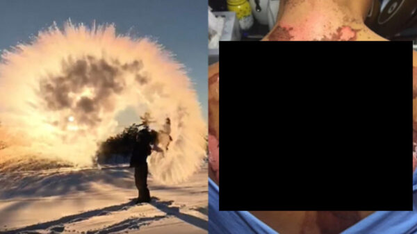 Fotogenieke dame loopt 3e-graads brandwonden op als ze het perfecte plaatje wil schieten