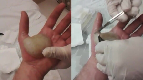 Een mega-blaar wegwerken is alleen voor mensen met een sterke maag