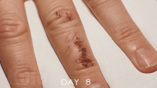 Time-lapse van een wondgenezing