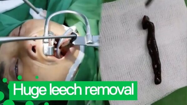 Doktoren trekken enorme bloedzuiger bij een vrouw uit de keel