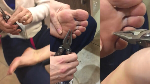 De grootste splinter ter wereld verwijder je met een punttang